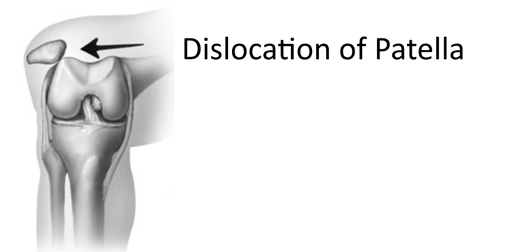 Patella Dislocations – Diagnosis, Treatment & Prevention