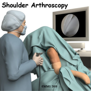 Shoulder Arthroscopy Surgery