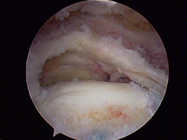 Rotator Cuff Tear