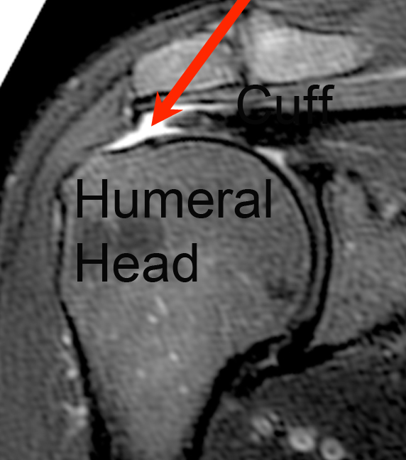 Cuff Humeral Head
