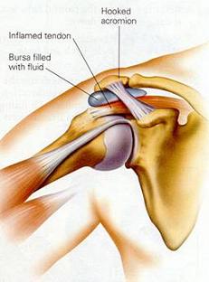 Rotator Cuff Impingement