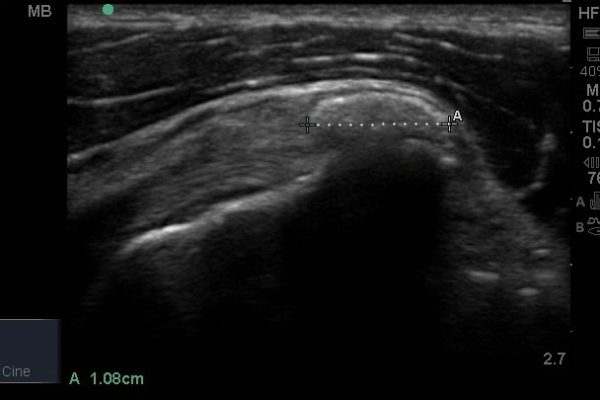 Calcific cuff tendinitis ultrasound scan