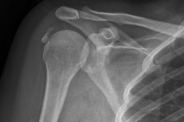 Calcific cuff tendinitis XRays