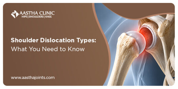 Illustration showing a shoulder dislocation with the upper arm bone displaced from the shoulder socket.